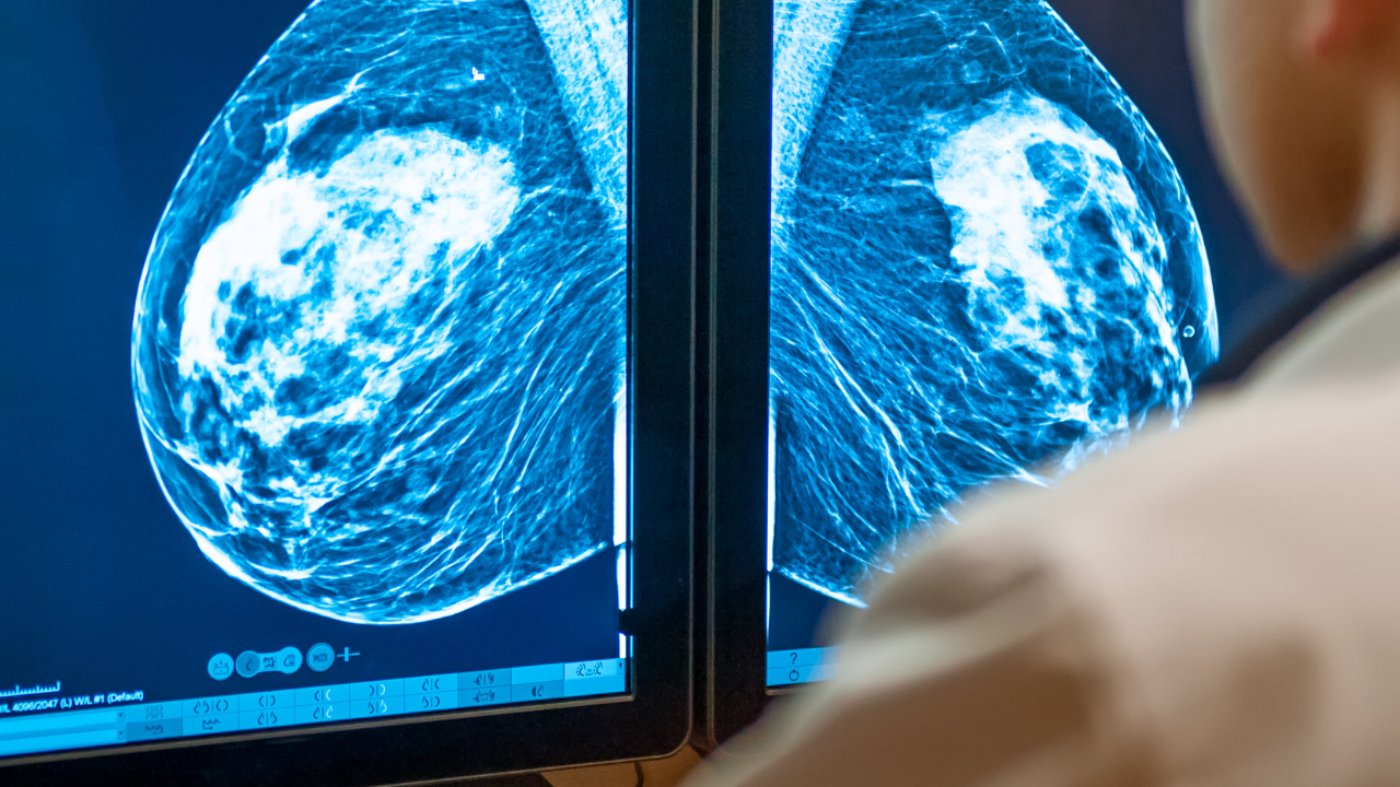 「高濃度乳腺（デンスブレスト）」とは？乳がん検診で知っておくべきこと