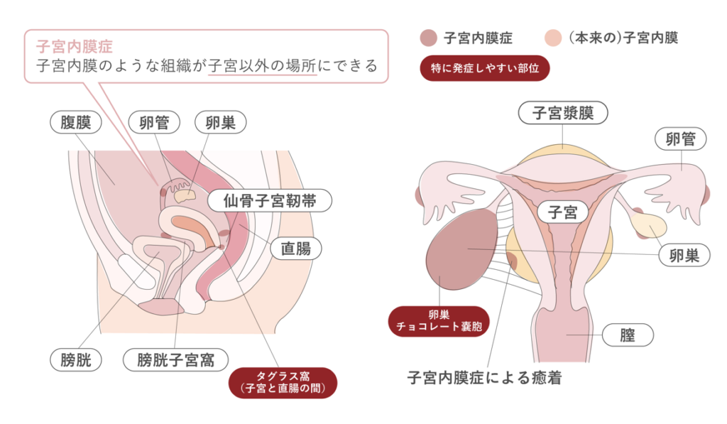 月経(生理)の異常・月経困難症|原因となる女性疾患について【医師監修】