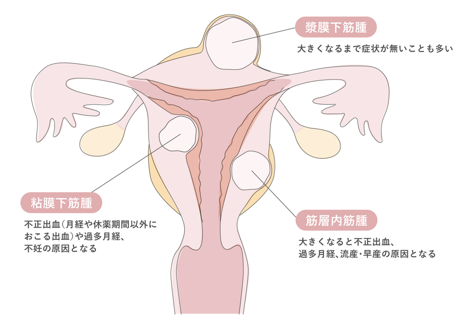 月経(生理)の異常・月経困難症|原因となる女性疾患について【医師監修】