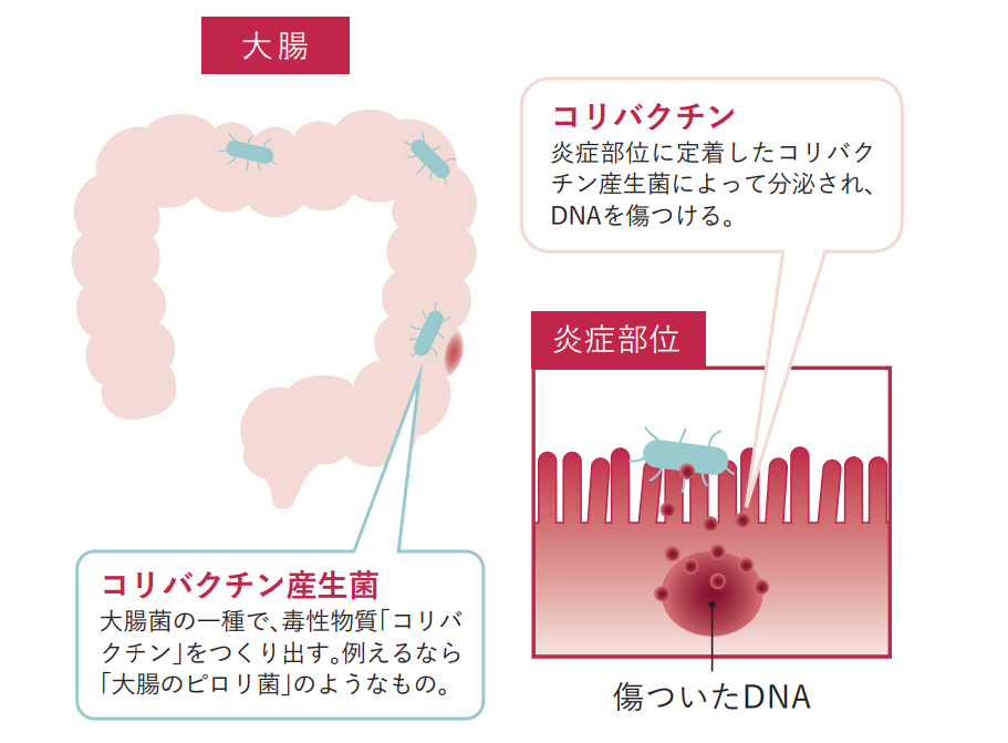 「大腸がん」の初期症状と原因とは?早期発見につながる3つの検査と重要性