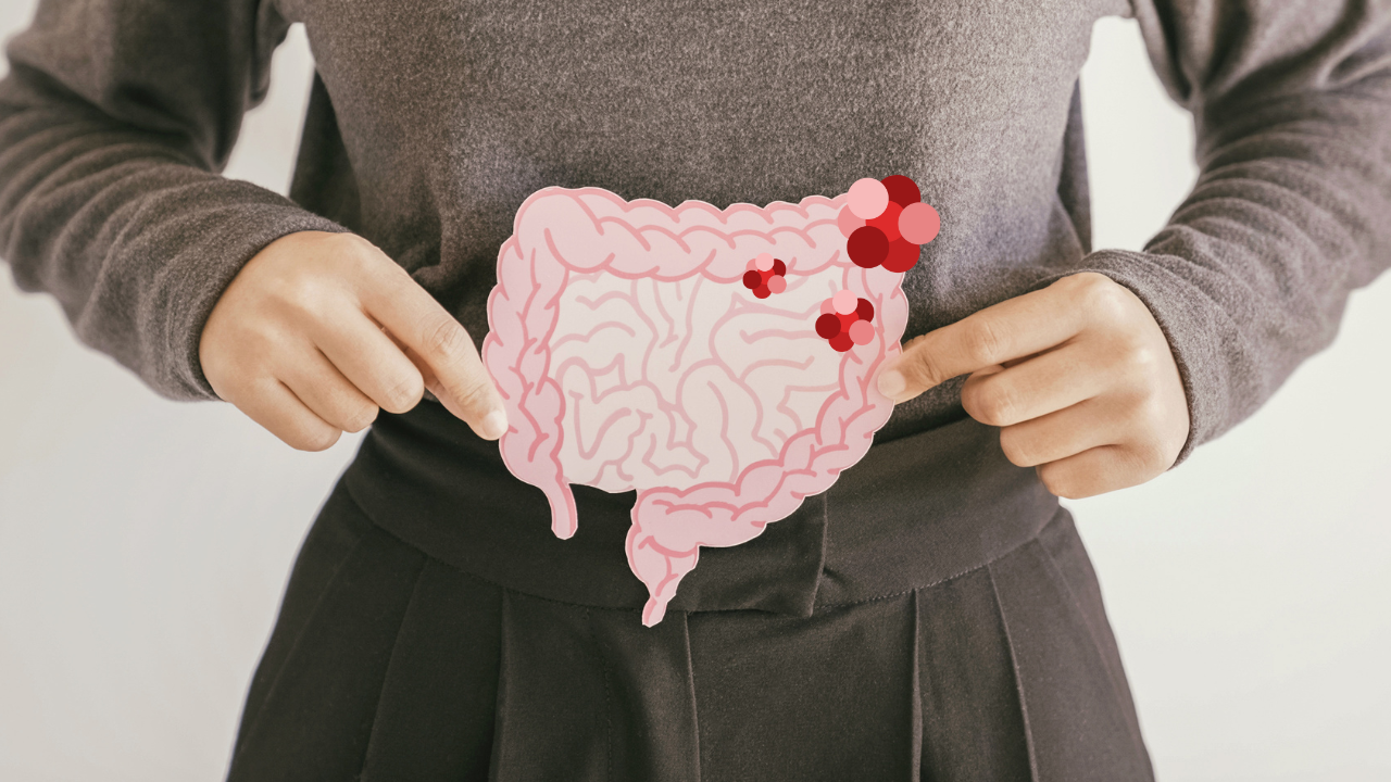 「大腸がん」の初期症状と原因とは？早期発見につながる検査の重要性