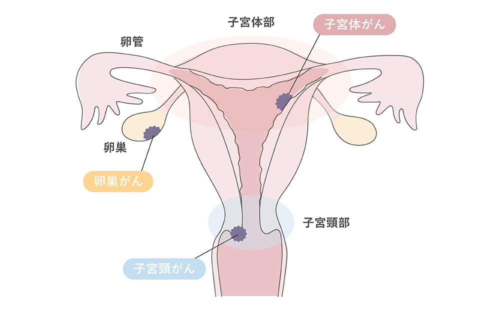子宮にできるがん・部位別の違い(子宮頸がん・子宮体がん・卵巣がん)
